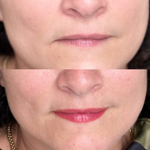 Gyógyult ajaktetoválások Gyógyult ajaktetoválások