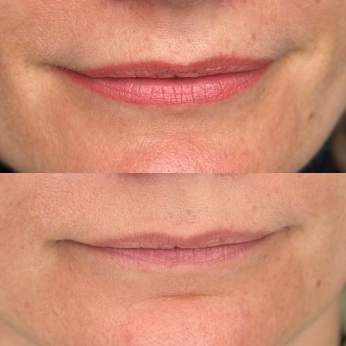 Gyógyult ajaktetoválások Gyógyult ajaktetoválások