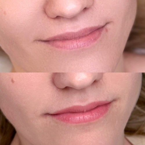 Gyógyult ajaktetoválások Gyógyult ajaktetoválások