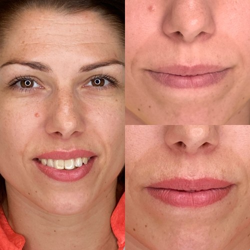 Gyógyult ajaktetoválások Gyógyult ajaktetoválások