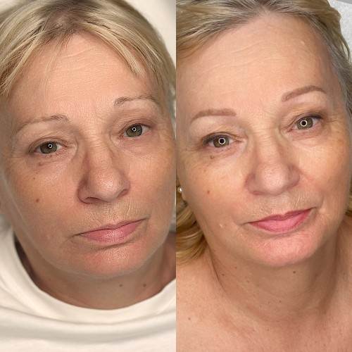 Gyógyult ajaktetoválások Gyógyult ajaktetoválások