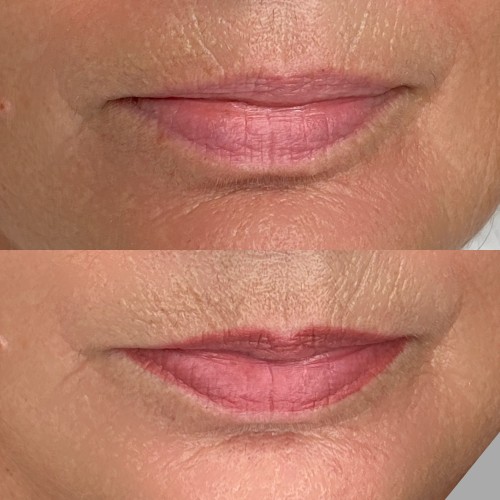 Gyógyult ajaktetoválások Gyógyult ajaktetoválások