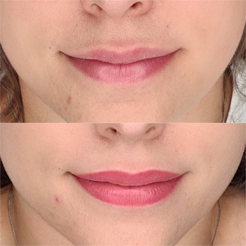 Gyógyult ajaktetoválások Gyógyult ajaktetoválások