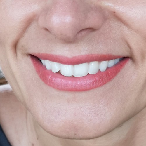 Gyógyult ajaktetoválások Gyógyult ajaktetoválások