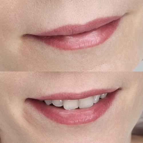 Gyógyult ajaktetoválások Gyógyult ajaktetoválások