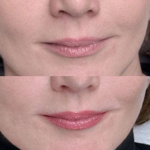 Gyógyult ajaktetoválások Gyógyult ajaktetoválások