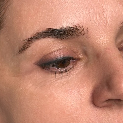 Gyógyult szemhéjtetoválások